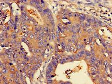 NMI Antibody - Immunohistochemistry of paraffin-embedded human colon cancer at dilution of 1:100