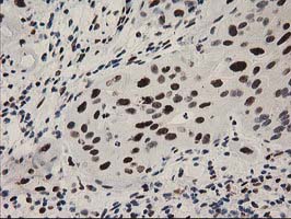 NMNAT1 / NMNAT Antibody - IHC of paraffin-embedded Carcinoma of Human bladder tissue using anti-NMNAT1 mouse monoclonal antibody. (Heat-induced epitope retrieval by 10mM citric buffer, pH6.0, 100C for 10min).