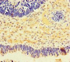 NMNAT2 Antibody - Immunohistochemistry of paraffin-embedded human ovarian cancer at dilution of 1:100