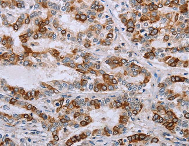 NMT1 Antibody - Immunohistochemistry of paraffin-embedded Human cervical cancer using NMT1 Polyclonal Antibody at dilution of 1:45.