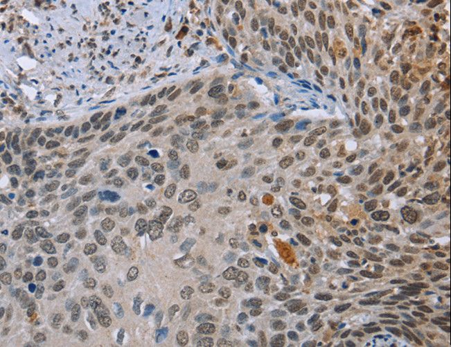 NMT1 Antibody - Immunohistochemistry of paraffin-embedded Human cervical cancer using NMT1 Polyclonal Antibody at dilution of 1:45.