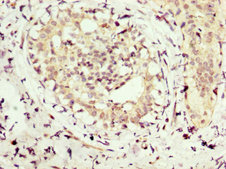 NMT1 Antibody - Immunohistochemistry image at a dilution of 1:300 and staining in paraffin-embedded human breast cancer performed on a Leica BondTM system. After dewaxing and hydration, antigen retrieval was mediated by high pressure in a citrate buffer (pH 6.0) . Section was blocked with 10% normal goat serum 30min at RT. Then primary antibody (1% BSA) was incubated at 4 °C overnight. The primary is detected by a biotinylated secondary antibody and visualized using an HRP conjugated SP system.