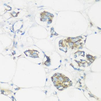 NMT1 Antibody - Immunohistochemistry of paraffin-embedded Human mammary cancer using NMT1 Polyclonal Antibody at dilution of 1:100 (40x lens).