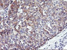 NMT2 Antibody - IHC of paraffin-embedded Adenocarcinoma of Human ovary tissue using anti-NMT2 mouse monoclonal antibody.