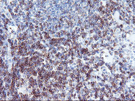 NMT2 Antibody - IHC of paraffin-embedded Human lymphoma tissue using anti-NMT2 mouse monoclonal antibody.