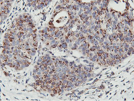 NMT2 Antibody - IHC of paraffin-embedded Carcinoma of Human lung tissue using anti-NMT2 mouse monoclonal antibody.