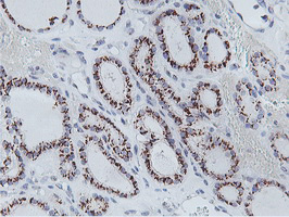 NMT2 Antibody - IHC of paraffin-embedded Carcinoma of Human thyroid tissue using anti-NMT2 mouse monoclonal antibody.