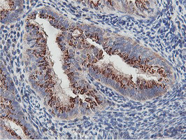 NMT2 Antibody - IHC of paraffin-embedded Adenocarcinoma of Human endometrium tissue using anti-NMT2 mouse monoclonal antibody.
