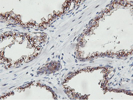NMT2 Antibody - IHC of paraffin-embedded Carcinoma of Human prostate tissue using anti-NMT2 mouse monoclonal antibody.
