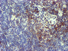 NMT2 Antibody - IHC of paraffin-embedded Human lymphoma tissue using anti-NMT2 mouse monoclonal antibody.