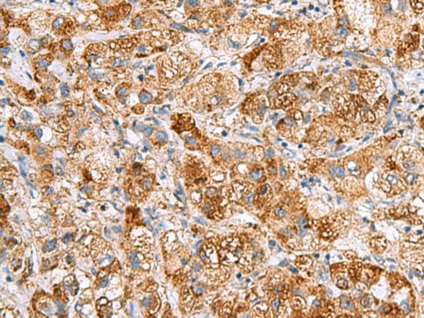 NMU / Neuromedin U Antibody - Immunohistochemistry of paraffin-embedded Human liver cancer tissue  using NMU Polyclonal Antibody at dilution of 1:80(×200)