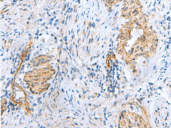 NMU / Neuromedin U Antibody - Immunohistochemistry of paraffin-embedded Human cervical cancer tissue  using NMU Polyclonal Antibody at dilution of 1:60(×200)