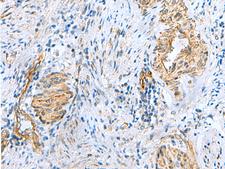 NMU / Neuromedin U Antibody - Immunohistochemistry of paraffin-embedded Human cervical cancer tissue  using NMU Polyclonal Antibody at dilution of 1:60(×200)