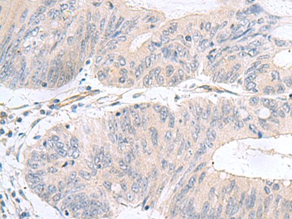 NMU / Neuromedin U Antibody - Immunohistochemistry of paraffin-embedded Human colorectal cancer tissue  using NMU Polyclonal Antibody at dilution of 1:60(×200)