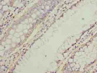 NMUR1 Antibody - Immunohistochemistry of paraffin-embedded human colon cancer using antibody at dilution of 1:100.