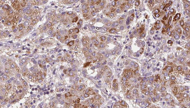 NMUR1 Antibody - 1:100 staining human liver carcinoma tissues by IHC-P. The sample was formaldehyde fixed and a heat mediated antigen retrieval step in citrate buffer was performed. The sample was then blocked and incubated with the antibody for 1.5 hours at 22°C. An HRP conjugated goat anti-rabbit antibody was used as the secondary.