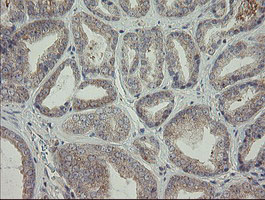 NNA1 / AGTPBP1 Antibody - IHC of paraffin-embedded Carcinoma of Human prostate tissue using anti-AGTPBP1 mouse monoclonal antibody.