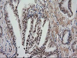 NNMT Antibody - IHC of paraffin-embedded Carcinoma of Human prostate tissue using anti-NNMT mouse monoclonal antibody.