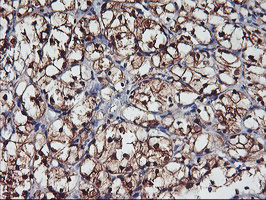 NNMT Antibody - IHC of paraffin-embedded Carcinoma of Human kidney tissue using anti-NNMT mouse monoclonal antibody.