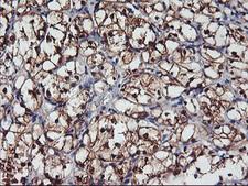 NNMT Antibody - IHC of paraffin-embedded Carcinoma of Human kidney tissue using anti-NNMT mouse monoclonal antibody.