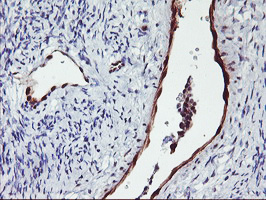 NNMT Antibody - IHC of paraffin-embedded Adenocarcinoma of Human ovary tissue using anti-NNMT mouse monoclonal antibody.