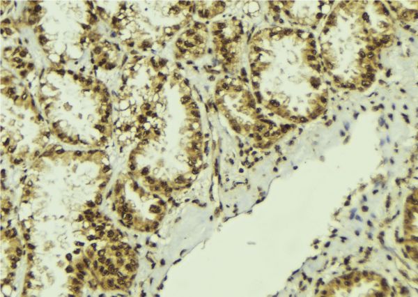 NOB1 / NOB1P Antibody - 1:100 staining human lung tissue by IHC-P. The sample was formaldehyde fixed and a heat mediated antigen retrieval step in citrate buffer was performed. The sample was then blocked and incubated with the antibody for 1.5 hours at 22°C. An HRP conjugated goat anti-rabbit antibody was used as the secondary.