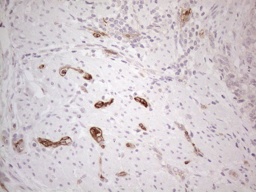 NOBOX Antibody - Immunohistochemical staining of paraffin-embedded Adenocarcinoma of Human endometrium tissue using anti-NOBOX mouse monoclonal antibody. (Heat-induced epitope retrieval by 1mM EDTA in 10mM Tris buffer. (pH8.5) at 120°C for 3 min. (1:150)