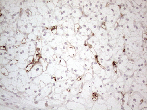 NOBOX Antibody - Immunohistochemical staining of paraffin-embedded Carcinoma of Human kidney tissue using anti-NOBOX mouse monoclonal antibody. (Heat-induced epitope retrieval by 1mM EDTA in 10mM Tris buffer. (pH8.5) at 120°C for 3 min. (1:150)