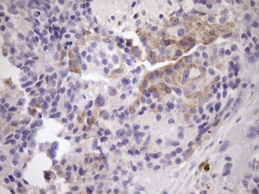 NOBOX Antibody - Immunohistochemical staining of paraffin-embedded Adenocarcinoma of Human breast tissue using anti-NOBOX mouse monoclonal antibody. (Heat-induced epitope retrieval by Tris-EDTA, pH8.0)(1:150)