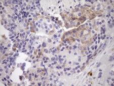 NOBOX Antibody - IHC of paraffin-embedded Adenocarcinoma of Human breast tissue using anti-NOBOX mouse monoclonal antibody. (Heat-induced epitope retrieval by Tris-EDTA, pH8.0)(1:150).
