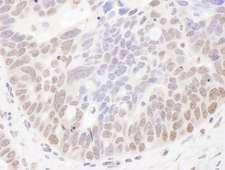 NOC2L Antibody - Detection of human NIR by immunohistochemistry. Sample: FFPE section of human ovarian carcinoma. Antibody: Affinity purified rabbit anti- NIR used at a dilution of 1:5,000 (0.2µg/ml). Detection: DAB. Counterstain: IHC Hematoxylin (blue).