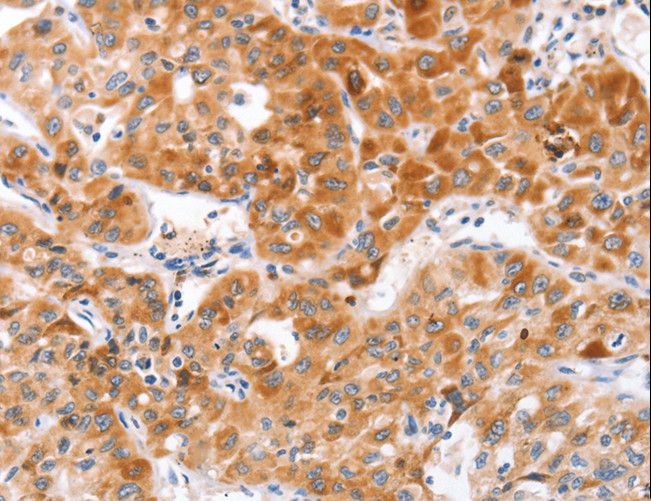 NOD1 Antibody - Immunohistochemistry of paraffin-embedded Human lung cancer using NOD1 Polyclonal Antibody at dilution of 1:50.