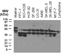 NOD2 / CARD15 Antibody - Western blot of NOD2 using Polyclonal Antibody to NOD2/CARD15 at 1:2000.30 ug total protein was loaded per lane. Samples from human tumor cell lines: PPC-1 (prostate carcinoma), NCI-H226and NCI-H332M (lung carcinoma), SF-268 (glioblastoma), UO-31 and A498 (renal/kidney carcinoma), SK-MEL-5 and SK-MEL-28 (melanoma), and MCF-7 (breast carcinoma). Lymphoma is from a cell line generated from a tumor growing in nude mice following injection of primary human lymphoma cells.