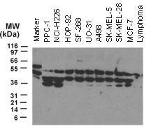 NOD2 / CARD15 Antibody - Fig-1: Western blot analysis of NOD2 using at 1:2000. 30 ug total protein was loaded per lane. Samples from human tumor cell lines: PPC-1 (prostate carcinoma), NCI-H226 and NCI-H332M (lung carcinoma), SF-268 (glioblastoma), UO-31 and A498 (renal/kidney carcinoma), SK-MEL-5 and SK-MEL-28 (melanoma), and MCF-7 (breast carcinoma). Lymphoma is from a cell line generated from a tumor growing in nude mice following injection of primary human lymphoma cells.