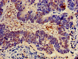 NOD2 / CARD15 Antibody - Immunohistochemistry of paraffin-embedded human ovarian cancer using NOD2 Antibody at dilution of 1:100