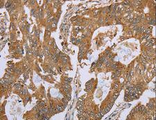 NOD8 / NLRP10 Antibody - Immunohistochemistry of paraffin-embedded Human gastric cancer using NLRP10 Polyclonal Antibody at dilution of 1:45.