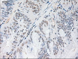 NOG / Noggin Antibody - Immunohistochemical staining of paraffin-embedded Adenocarcinoma of colon using anti-Nog mouse monoclonal antibody.