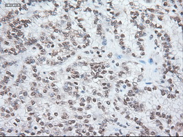 NOG / Noggin Antibody - Immunohistochemical staining of paraffin-embedded Carcinoma of kidney using anti-Nog mouse monoclonal antibody.