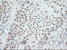 NOG / Noggin Antibody - Immunohistochemical staining of paraffin-embedded Carcinoma of lung using anti-Nog mouse monoclonal antibody.