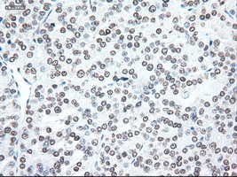 NOG / Noggin Antibody - Immunohistochemical staining of paraffin-embedded Carcinoma of thyroid using anti-Nog mouse monoclonal antibody.