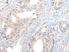 NOG / Noggin Antibody - Immunohistochemistry of paraffin-embedded Human gastric cancer tissue  using NOG Polyclonal Antibody at dilution of 1:50(×200)