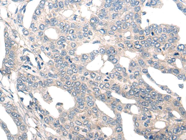 NOG / Noggin Antibody - Immunohistochemistry of paraffin-embedded Human liver cancer tissue  using NOG Polyclonal Antibody at dilution of 1:50(×200)