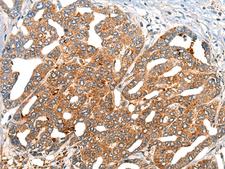 NOG / Noggin Antibody - Immunohistochemistry of paraffin-embedded Human liver cancer tissue  using NOG Polyclonal Antibody at dilution of 1:40(×200)