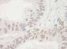 NOL10 Antibody - Detection of Human NOL10 by Immunohistochemistry. Sample: FFPE section of human breast carcinoma. Antibody: Affinity purified rabbit anti-NOL10 used at a dilution of 1:5000 (0.2 ug/mg).