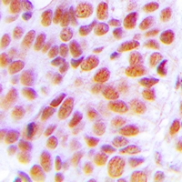 NOL10 Antibody - Immunohistochemical analysis of NOL10 staining in human breast cancer formalin fixed paraffin embedded tissue section. The section was pre-treated using heat mediated antigen retrieval with sodium citrate buffer (pH 6.0). The section was then incubated with the antibody at room temperature and detected using an HRP conjugated compact polymer system. DAB was used as the chromogen. The section was then counterstained with haematoxylin and mounted with DPX.