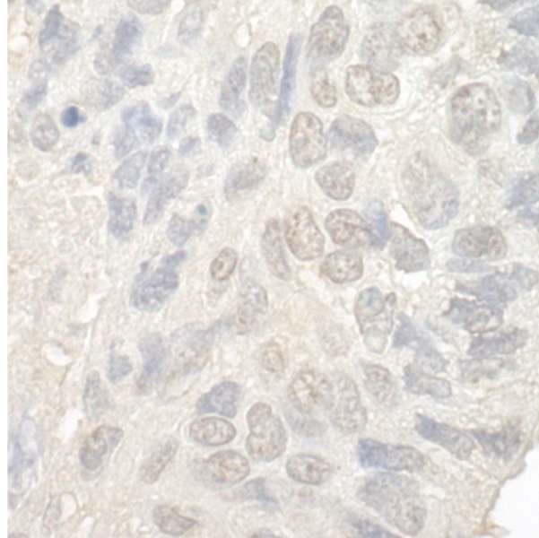 NOL12 Antibody - Detection of Human NOL12 by Immunohistochemistry. Sample: FFPE section of human lung carcinoma. Antibody: Affinity purified rabbit anti-NOL12 used at a dilution of 1:1000 (1 ug/mg).