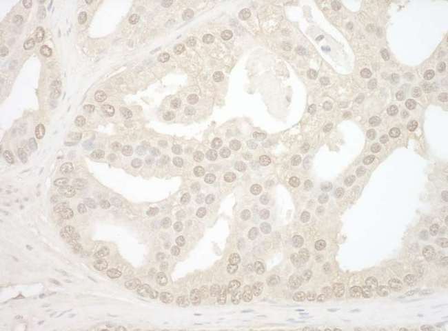 NOL12 Antibody - Detection of Human NOL12 by Immunohistochemistry. Sample: FFPE section of human prostate carcinoma. Antibody: Affinity purified rabbit anti-NOL12 used at a dilution of 1:1000 (1 ug/mg).