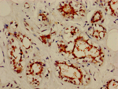 NOL3 / ARC Antibody - IHC image of NOL3 Antibody diluted at 1:800 and staining in paraffin-embedded human breast cancer performed on a Leica BondTM system. After dewaxing and hydration, antigen retrieval was mediated by high pressure in a citrate buffer (pH 6.0). Section was blocked with 10% normal goat serum 30min at RT. Then primary antibody (1% BSA) was incubated at 4°C overnight. The primary is detected by a biotinylated secondary antibody and visualized using an HRP conjugated SP system.