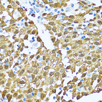 NOL3 / ARC Antibody - Immunohistochemistry of paraffin-embedded human lung cancer tissue.