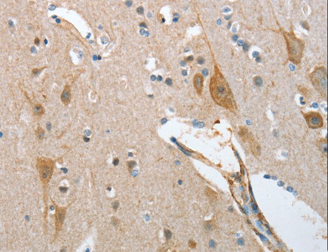 NOL3 / ARC Antibody - Immunohistochemistry of paraffin-embedded Human lung cancer using NOL3 Polyclonal Antibody at dilution of 1:35.